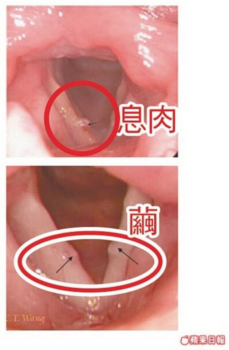 聲帶長繭┃從聲帶瘜肉變長繭 醫院嗓音治療 西藥中藥 澎大海等都試 吞嚥卡卡 無法久說快話長說 歷程分享